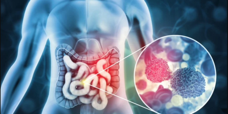 Hareketsizlik, Alkol ve Sigara, Kolon Kanseri Riskini Artırıyor